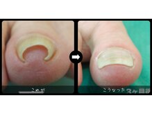 特殊プレートによる巻き爪の改善日本ネイリスト協会認定講師対応