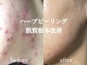 満足度No1【徹底改善set】水素水毛穴洗浄×ハーブピーリング/ハーブリプロ