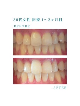 ミノリ(MINORI)/しみにくく痛みが少ない！