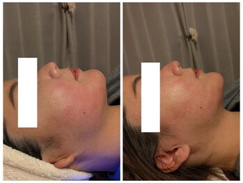 サロン ニコリー(Salon Nicolly)/レモンボトル2cc/before×after