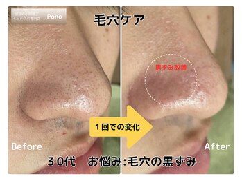 ポノ 甲府本店(pono)/毛穴にょきにょき