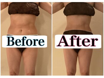 トータルビューティーサロン 凛/更年期前後のポッコリお腹も