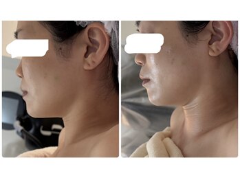 アルページュ(Arpege)/下顔面、中顔面短縮&ブライト