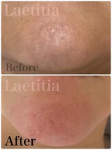 レティティア(Laetitia)/症例7【毛穴洗浄＆最新パック】