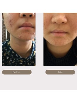 フルール 香椎駅前店(fleur)/ニキビケア