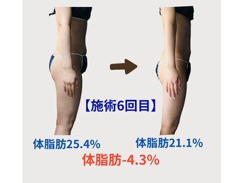 ネオボディ(Neo Body)/30代お客様◇6回目