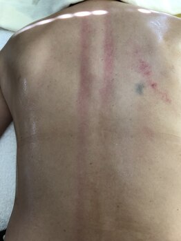 ナトゥラ/かっさ施術後