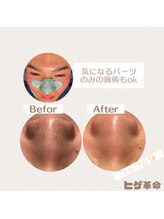 ヒゲ革命 難波日本橋/鼻の黒いポツポツ改善しませんか