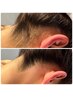◇【うなじ脱毛】｢その日今すぐキレイ」うなじ襟足ミックス脱毛13200→9900円