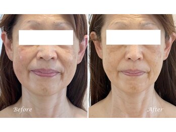 ドクターボディ 新宿店(Dr.Body)/【たるみ/ほうれい線 50代】