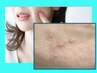 頑固な肌荒れ改善したい方へ★お試しニ施術★お悩みに特化した洗浄×BBL照射
