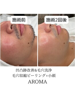 アロマ(AROMA)/赤み、毛穴改善／越谷
