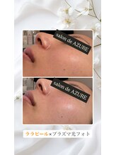 アズール 春日井店(AZURE)/ララピール×光フォト