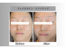 フェイシャルサロン セレスタイト/前方下垂型タイプ