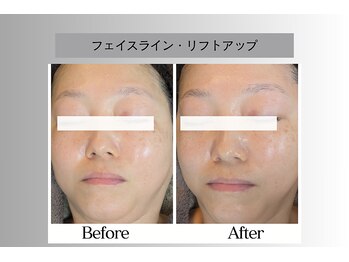 フェイシャルサロン セレスタイト/前方下垂型タイプ