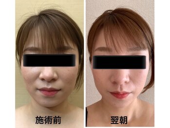 アールフェイスバランス/小顔矯正モニター様随時募集中