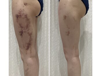 エスアール アミティ(SR Amity)/インディバ／術後ケア2回目After