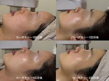 ハニエル(Haniel)の雰囲気（輪郭と肌が格段に整うカーボキシーは、ブライダルにも大人気☆）