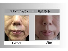 フェイシャルサロン セレスタイト/下顔面の集中ケアで小顔