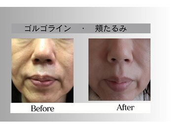 フェイシャルサロン セレスタイト/下顔面の集中ケアで小顔