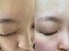 【毛穴ケア脱毛×肌荒れ予防】顔脱毛で土台が整う美肌プラン★美肌パック付き