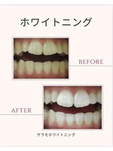 サラモ(Sa La Mo)/セルフホワイトニング