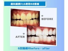 スマイルホワイト 赤羽店/ホワイトニングBefore After