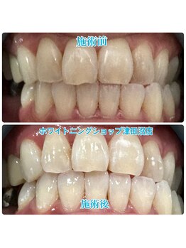ホワイトニングショップ 津田沼店/before&after美白ホワイトニング