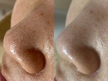 黒ずみを除去だけでなく引き締めにも◎