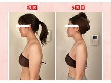 リラココ(リラcoco)/ビフォーアフター（20代お客様）