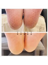 アイラッシュサロンアールツー(eyelash salon R2)/角質ケア