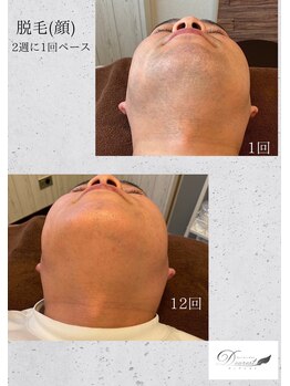 ディアレスト(Dearest)/メンズ 顔 脱毛