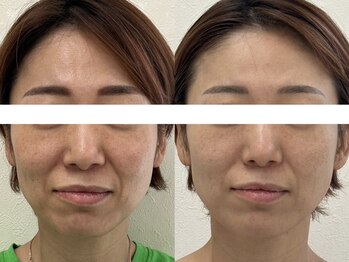 サクラ(SAKURA)/本厚木/フェイシャル/シミ