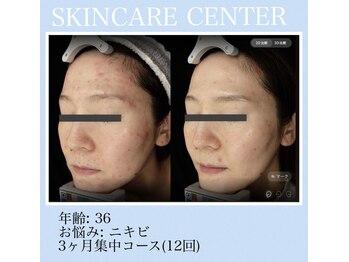 アンジェラックス スキンケアセンター 渋谷/ニキビケア症例