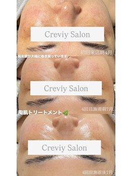 クレヴィー(Creviy)/陶肌トリートメント4回の変化
