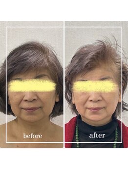 リリーガーデン 手稲店(Lily Garden)/ビフォーアフター 小顔/くすみ