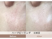 ルピア(L'pur)の雰囲気（【ビフォーアフター】大人気★ハーブピーリング！）