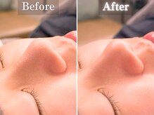 ボーンオム(Born Homme)/毛穴洗浄＋美容液導入：20代女性