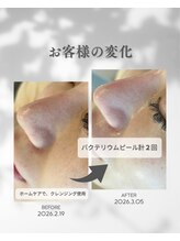 プレジール(Plaisir)/お手入れ2回・ホームケア使用