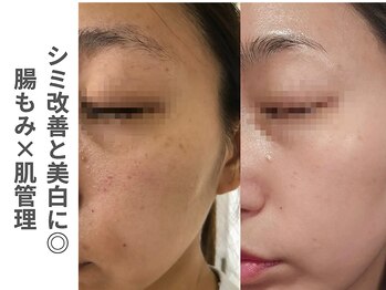 ソルレ 宮崎店(SOLURe)/シミ改善と美白 腸もみ×肌管理