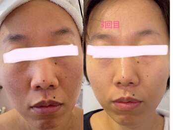 ヒメミ(Himemi)/BBL光エステ3回目照射後のお写真