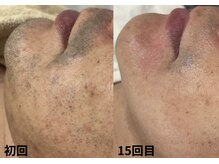 アヴィーシャル(abeshial)の雰囲気（肌も綺麗にする脱毛♪肌が綺麗な男子はモテます！）