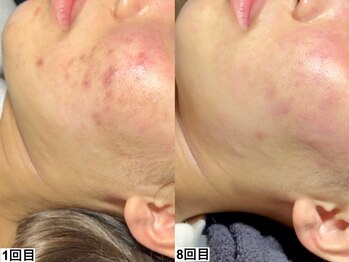 アンドミー 西宮北口店(&me)/ハーブピーリング【ニキビケア】