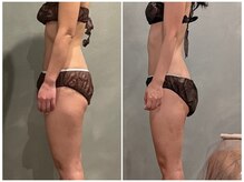 ツーアップ(2up)/前ももパンパン解消