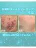 【毛穴×凸凹×ニキビ】結果重視の改善術◎幹細胞ゴールドピーリング¥27000
