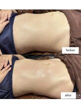 ウェルフォーセルフ(WELL FOR SELF)/ラジオ波×吸引×もみ出し