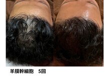 ボニータ(Bonita)/【頭皮Lit】ヒト羊膜幹細胞