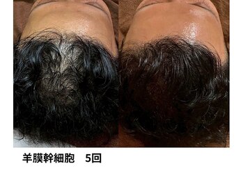 ボニータ(Bonita)/【頭皮Lit】ヒト羊膜幹細胞