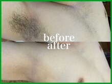 ハモンド(Hammond)/ワキ・胸毛・乳輪脱毛