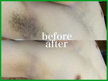 ハモンド(Hammond)/ワキ・胸毛・乳輪脱毛